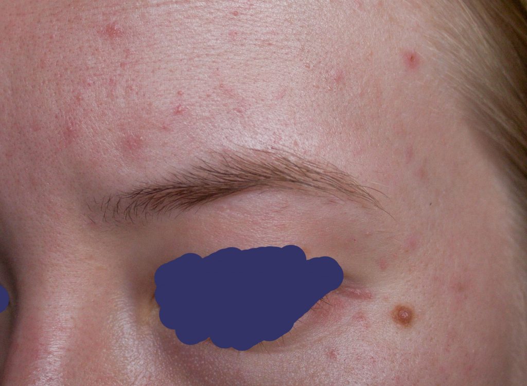 infection near eye