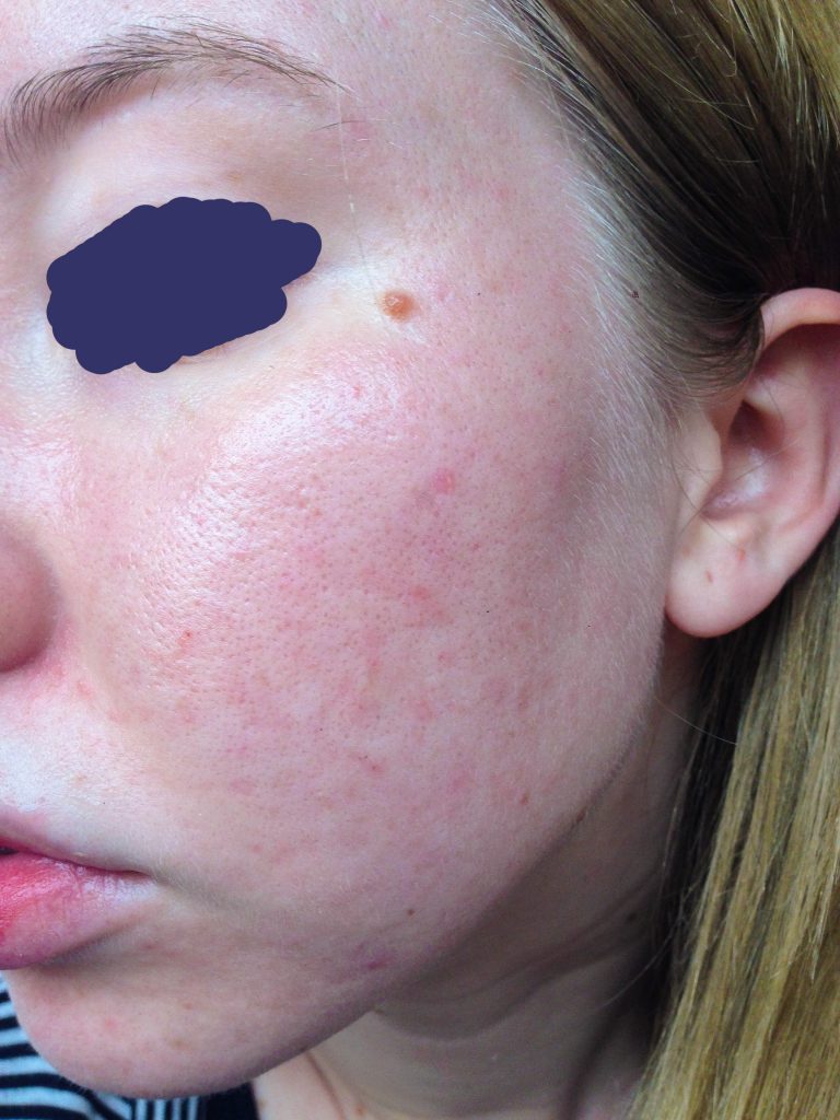 beginning of skin rash