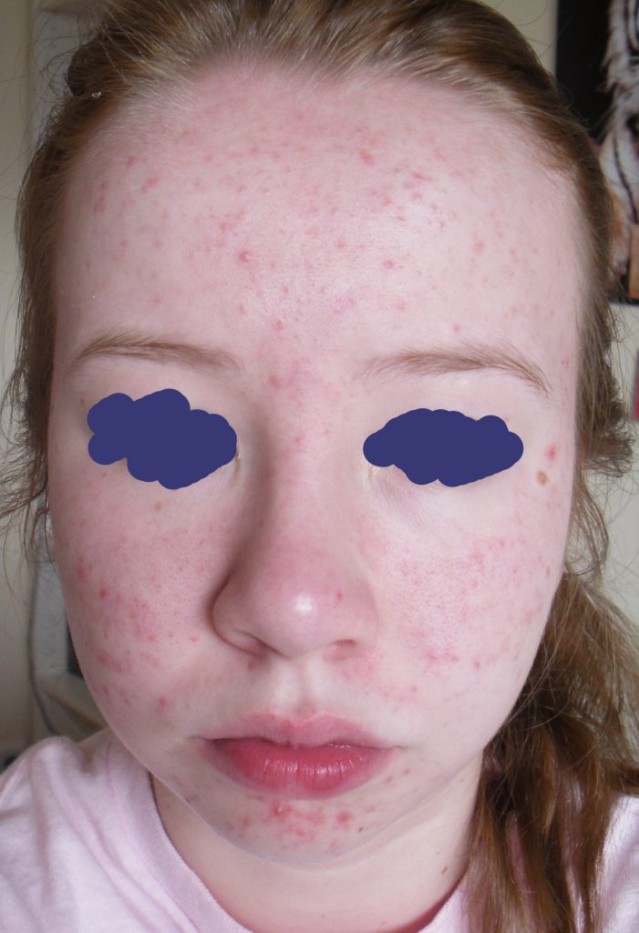 acne in early teens