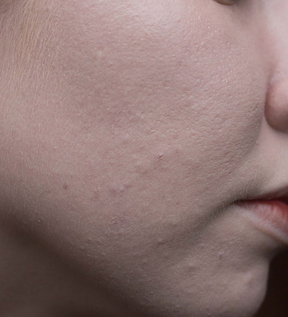 Skin after two layers of The Ordinary Colour Serum Foundation