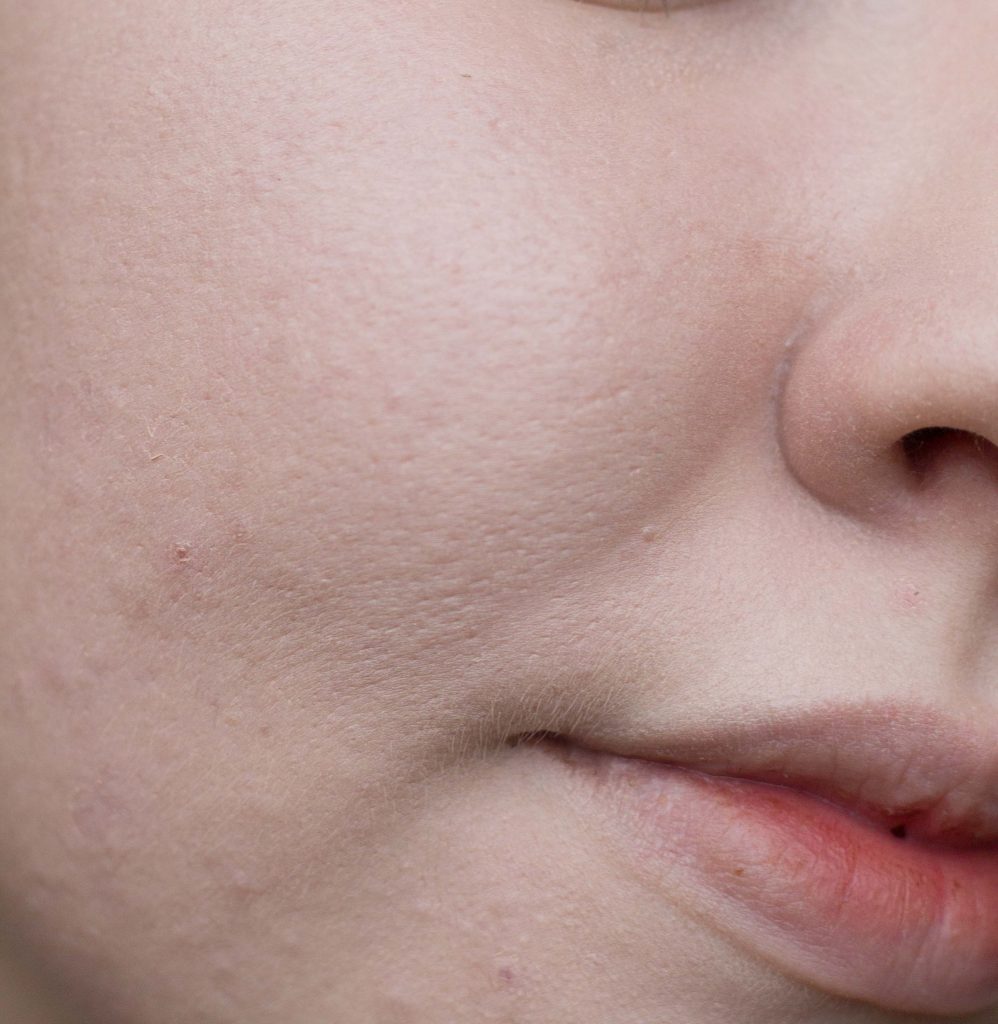 Pores and skin texture wearing The Ordinary Colours Serum Foundation