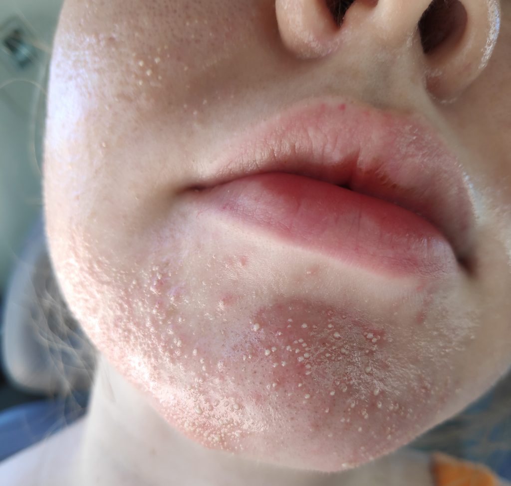 Fungal Acne What Is Fungal Acne And How Do I Treat It How