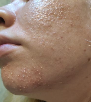 From Fungal Acne/Folliculitis to Clear Skin (with Pictures ...