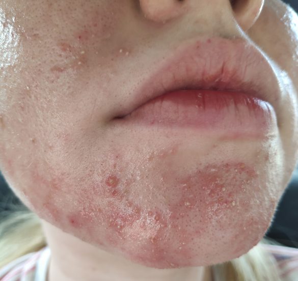 From Fungal Acne/Folliculitis to Clear Skin (with Pictures) Skin Careless