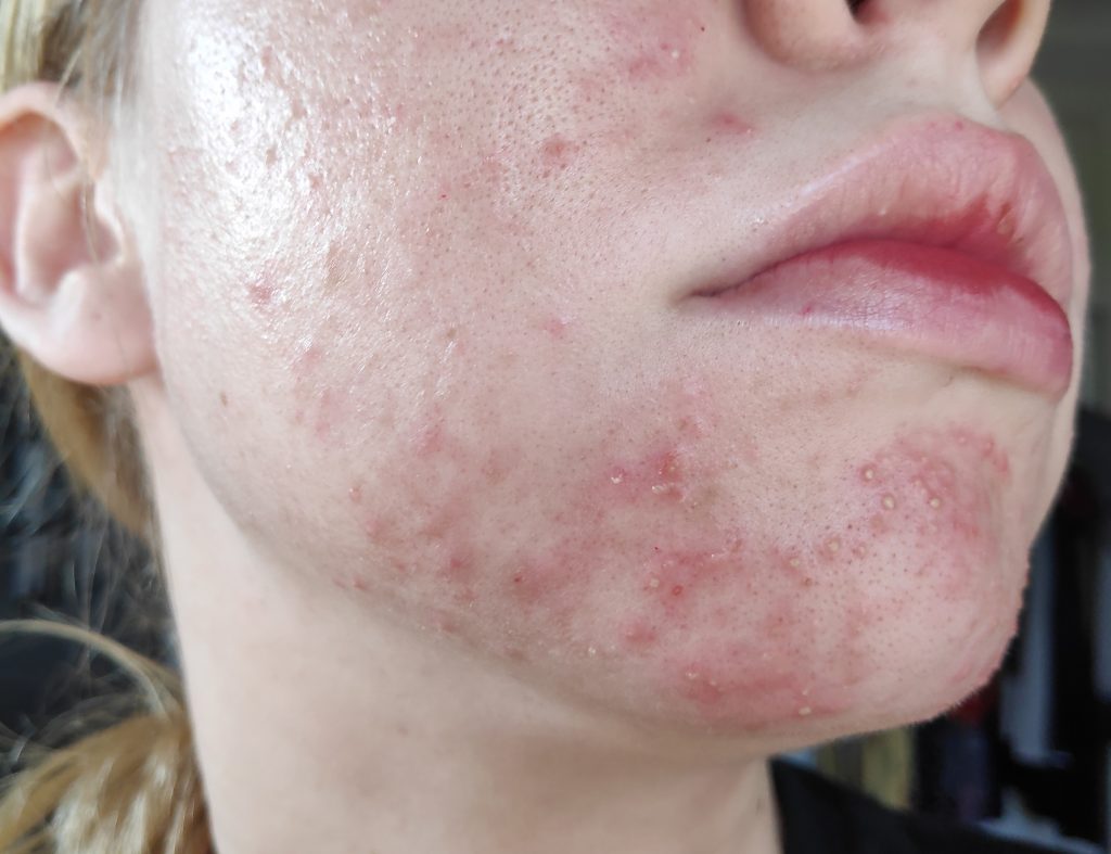 From Fungal Acne Folliculitis To Clear Skin with Pictures Skin Careless