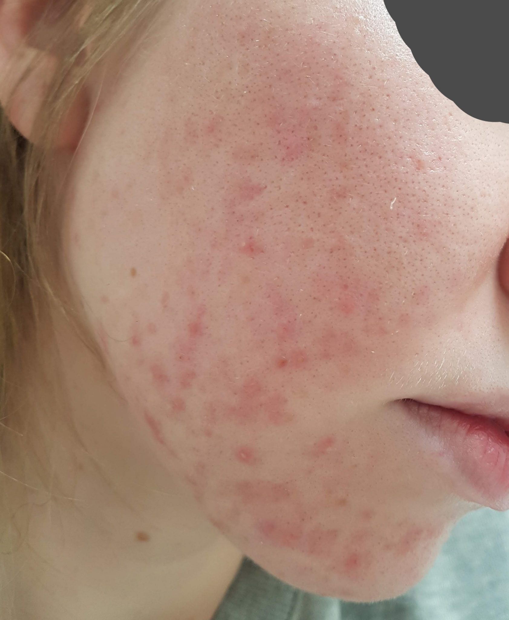 From Fungal Acne/Folliculitis to Clear Skin (with Pictures) | Skin Careless