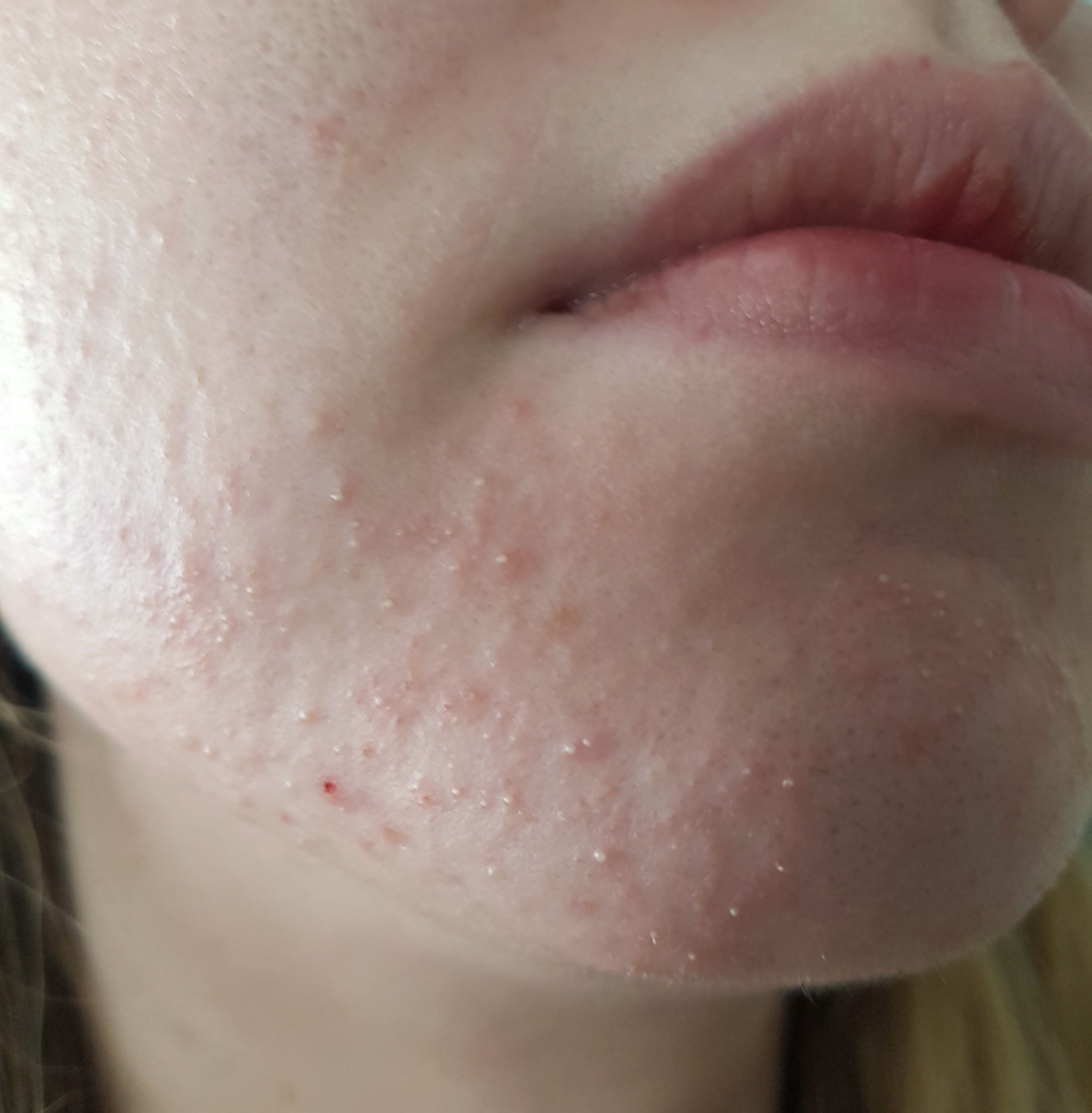 How To Identify Fungal Acne Treatments Vrogue co