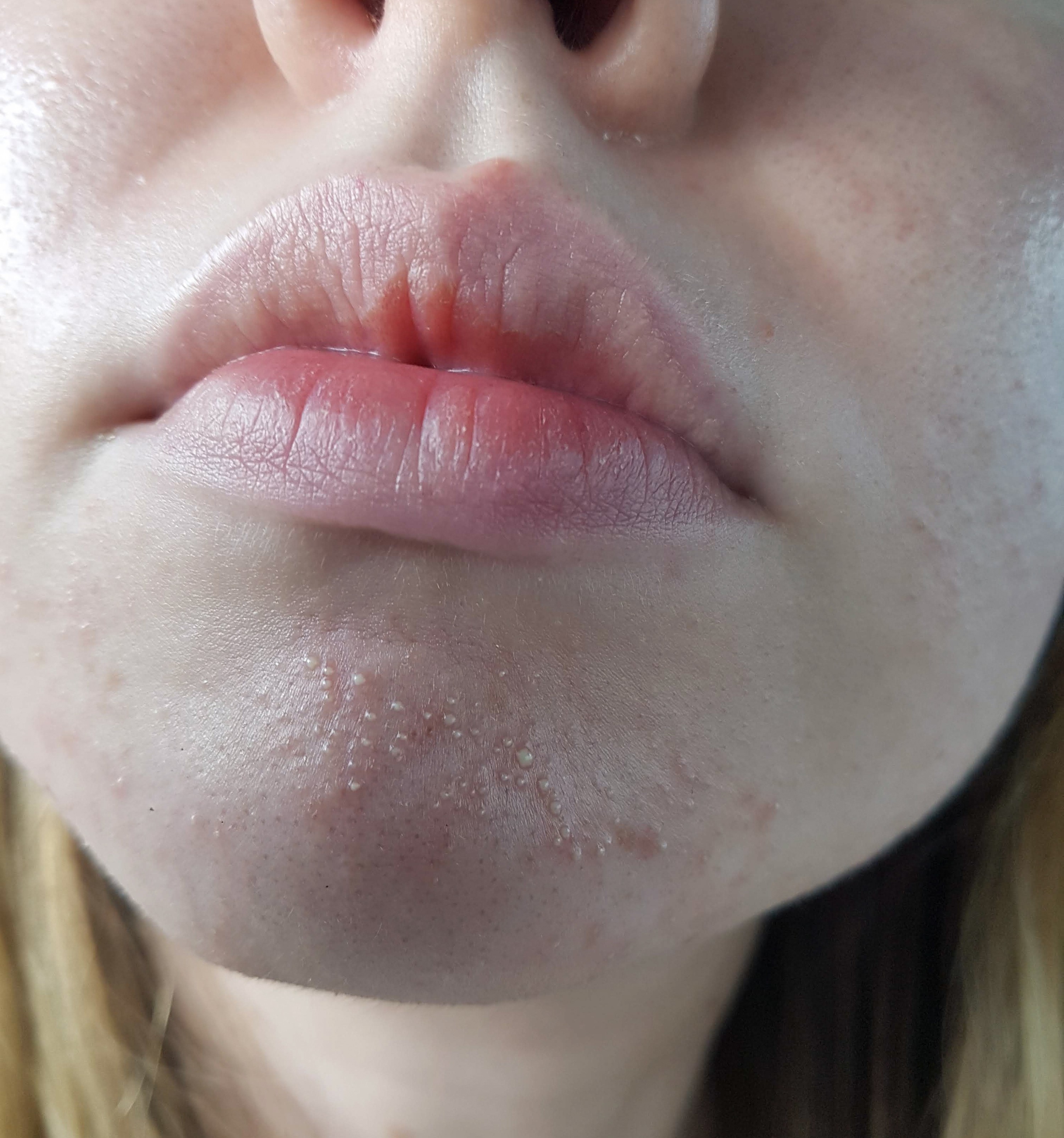 From Fungal Acne/Folliculitis to Clear Skin (with Pictures) Skin Careless
