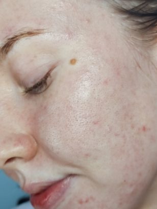 How to Do an At-Home DIY Hydrafacial | Skin Careless
