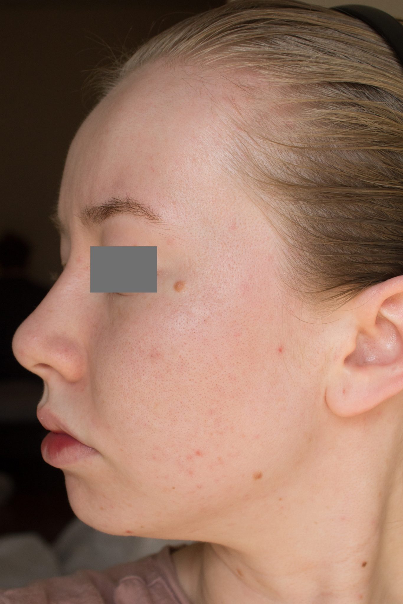 At-Home IPL Photofacial/Skin Rejuvenation (+ Photos) | Skin Careless