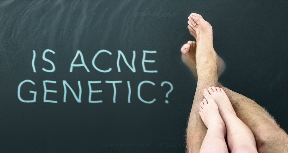 Is acne genetic?