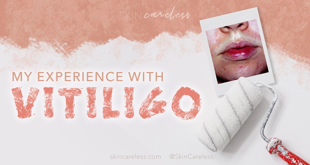My experience with vitiligo