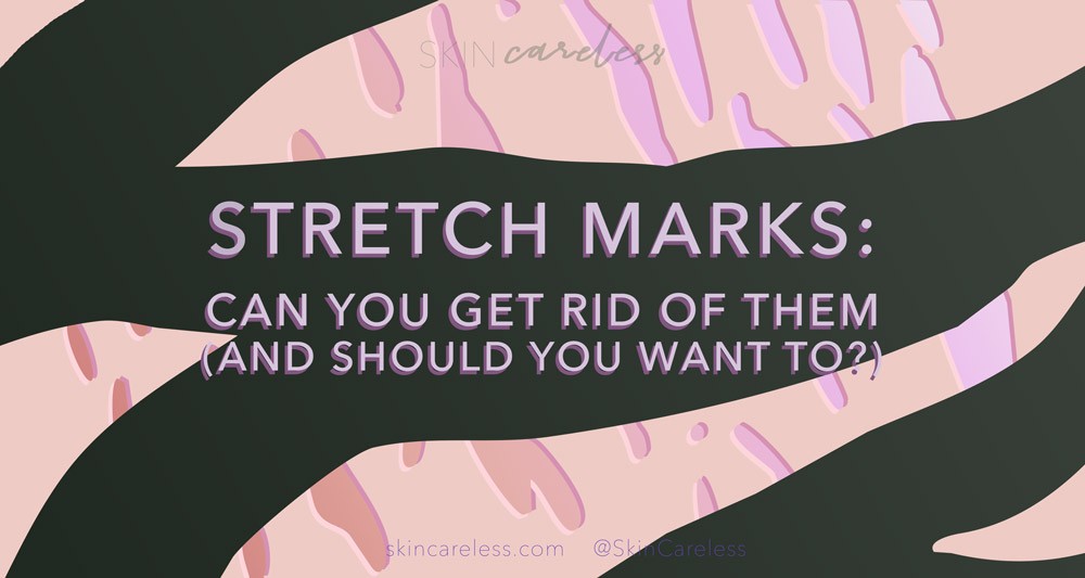 Stretch marks: can you get rid of them (and should you want to?)