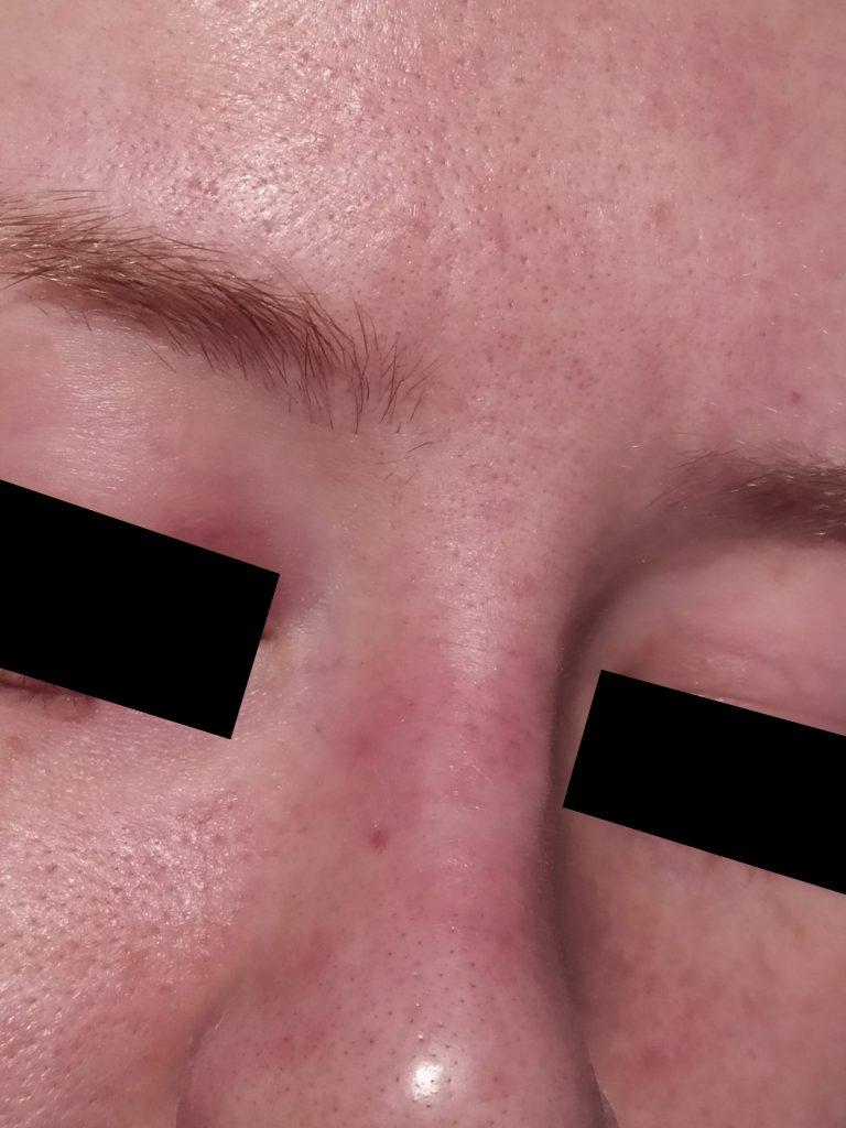 The Seborrhoeic Dermatitis Treatment + Maintenance Guide | Skin Careless