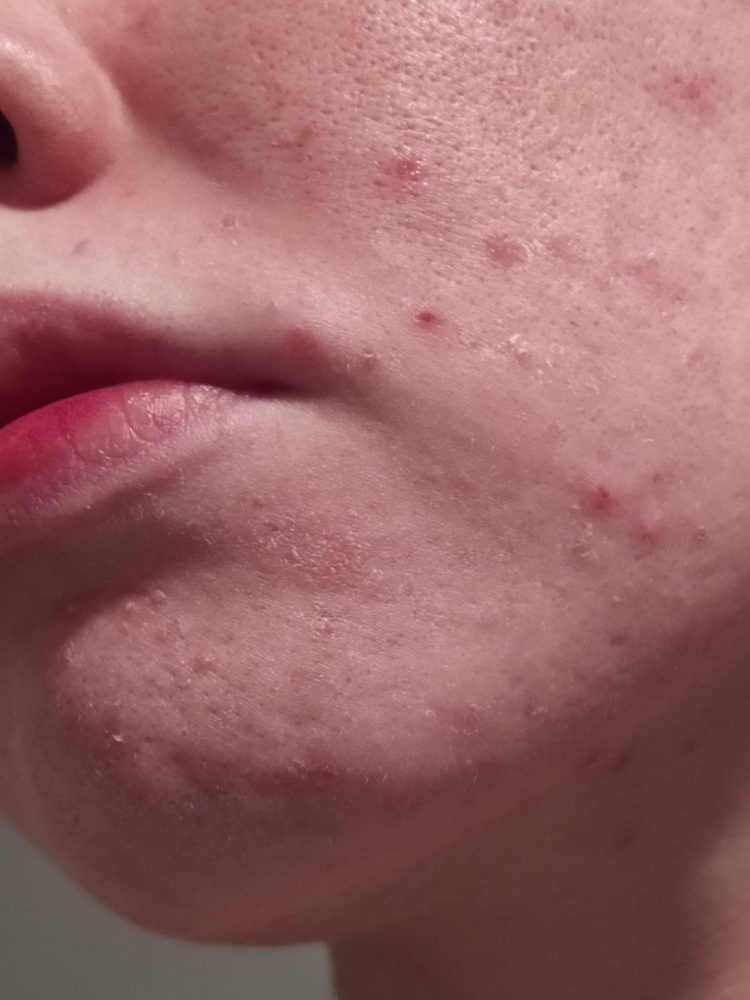 The Seborrhoeic Dermatitis Treatment + Maintenance Guide Skin Careless