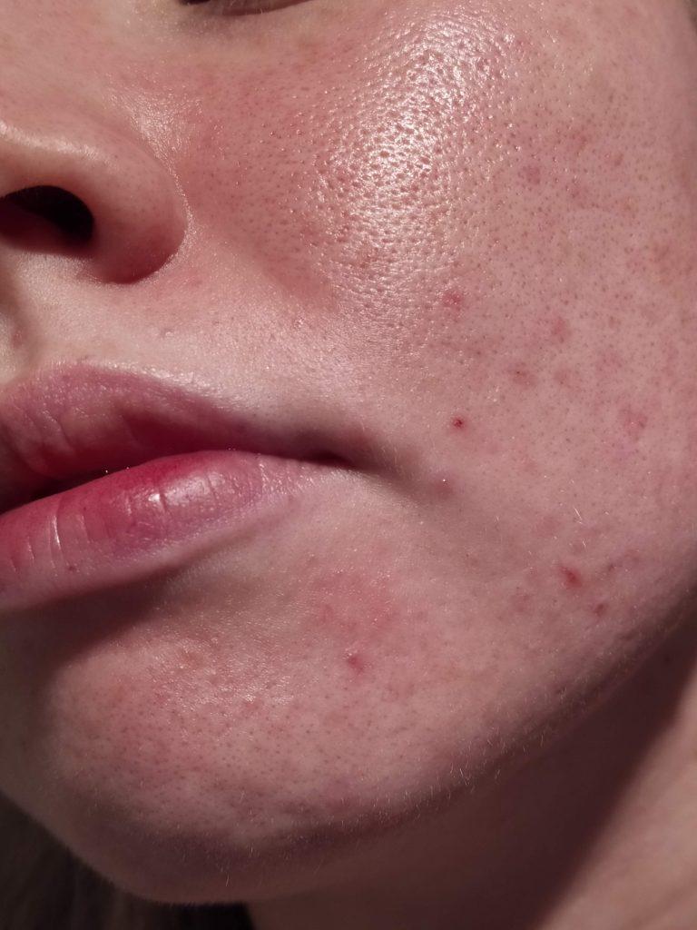 The Seborrhoeic Dermatitis Treatment + Maintenance Guide Skin Careless